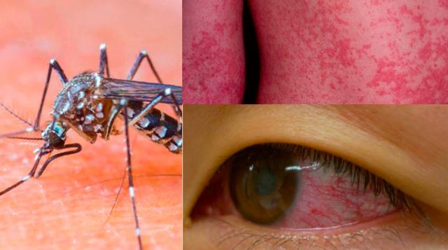 The Zika Virus and The Emerald Coast Panhandle Pensacola Florida